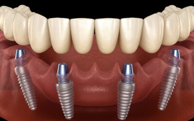 DENTAL IMPLANTS IN COLOMBIA